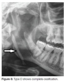 styloid process x ray