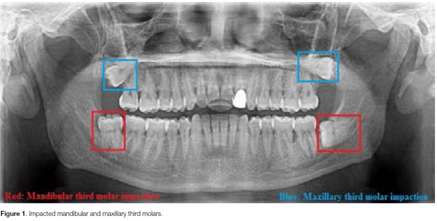 inverted impacted wisdom tooth