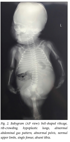 sirenomelia x ray