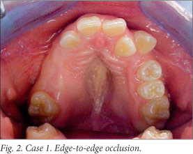 Rubinstein-Taybi syndrome: principal oral and dental disorders and  literature update