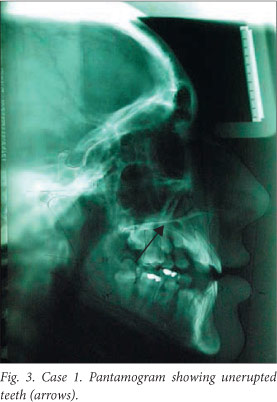 SciELO - Brasil - Prosthetic rehabilitation of a child with Rubinstein-Taybi  Syndrome after dental trauma: case report Prosthetic rehabilitation of a  child with Rubinstein-Taybi Syndrome after dental trauma: case report