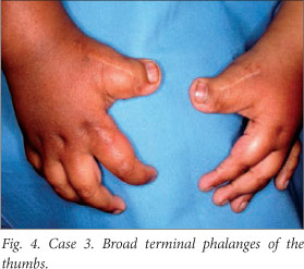 SciELO - Brasil - Broad thumbs and broad hallux: the hallmarks for the  Rubinstein-Taybi syndrome Broad thumbs and broad hallux: the hallmarks for  the Rubinstein-Taybi syndrome
