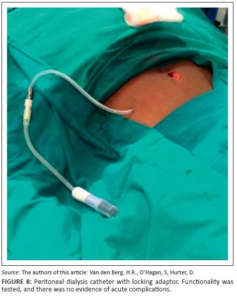 peritoneal dialysis catheter baxter