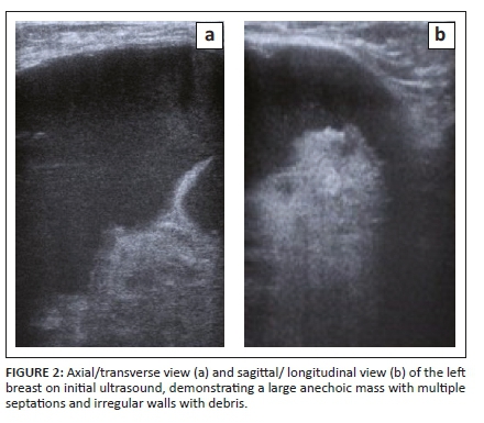 a patient with class iii breast who underwent spindle-shaped