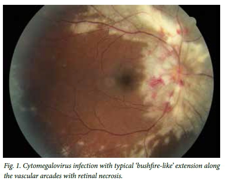 cytomegalovirus retinitis statistics