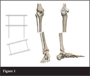 Tibia Fractures: Ilizarov / Circular Wire Fixators : Wheeless' Textbook of  Orthopaedics