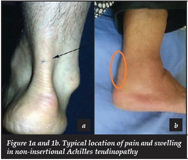 Achilles tendinopathy - Part 1 