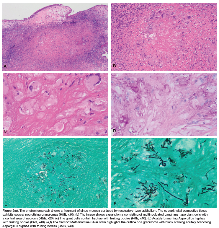 Chronic granulomatous invasive fungal maxillary sinusitis: Report of ...