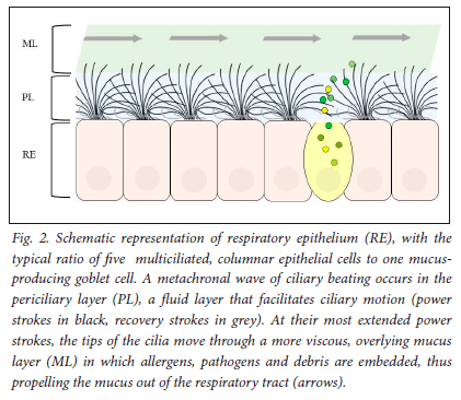 Primary Ciliary Dyskinesia Meeting The Challenges Of Diagnosis In 